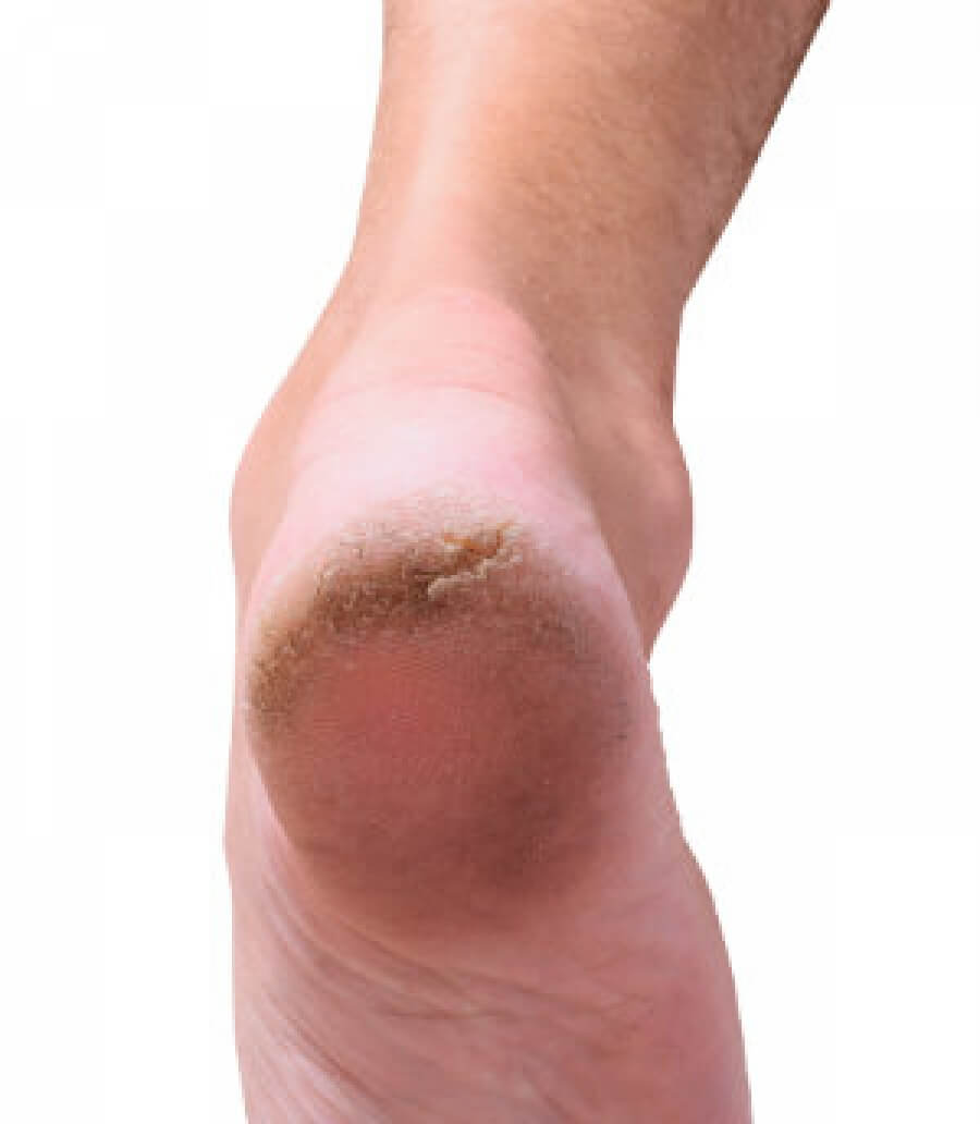 Crack Foot Protector Moisturizing Socks for Foot-Care | Heel Cracks | Heel  Swelling Pain Relief